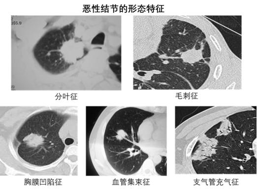 体检查出肺结节，严重吗？