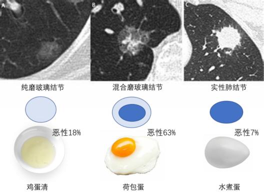 体检查出肺结节，严重吗？