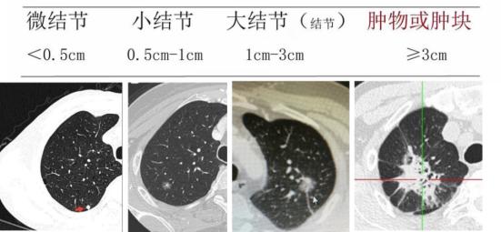 体检查出肺结节，严重吗？