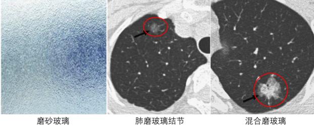 体检查出肺结节，严重吗？