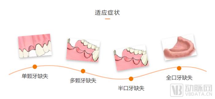 种植牙行业大洗牌