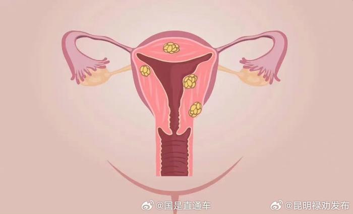 每5个成年女性约有1人患子宫肌瘤，孕激素可以刺激子宫肌瘤生长