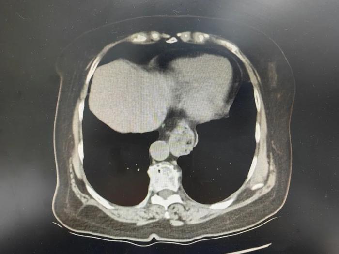 心慌老人10年未确诊，辗转多家医院终于确认病因......