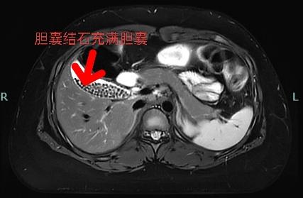 突发剧烈腹痛，医生从他肚里取出密密麻麻的“珍珠”