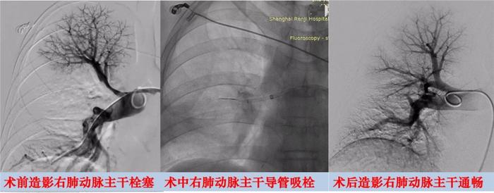 男子胸痛肺栓塞，上海专家采用新一代微创器械“吸出”血栓