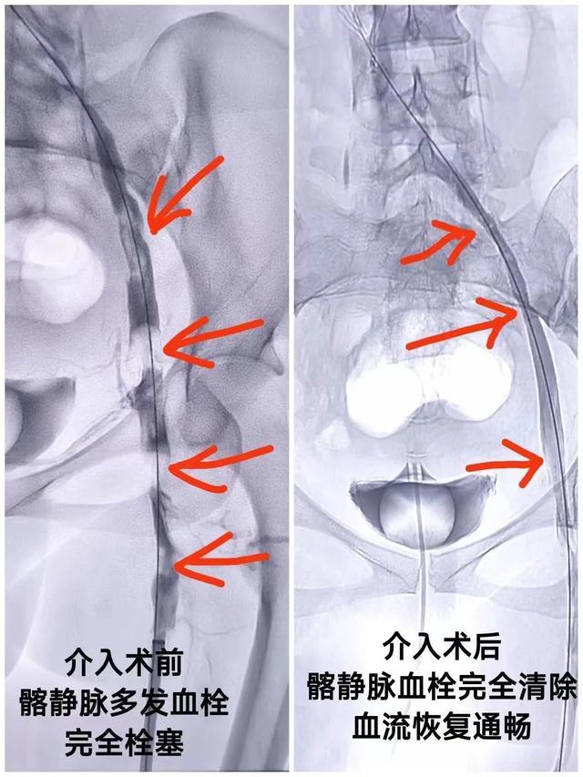 医生从女子左腿“掏出”三四十厘米血栓，只因她连续两个月吃了……