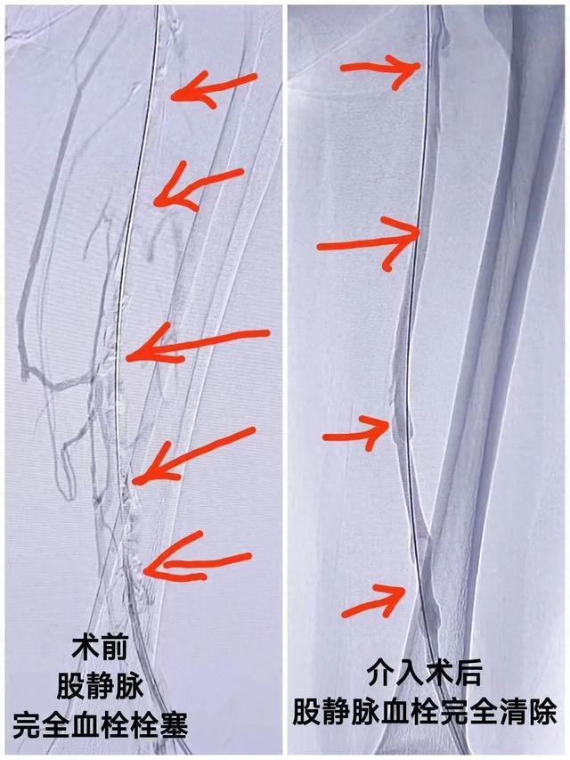 医生从女子左腿“掏出”三四十厘米血栓，只因她连续两个月吃了……