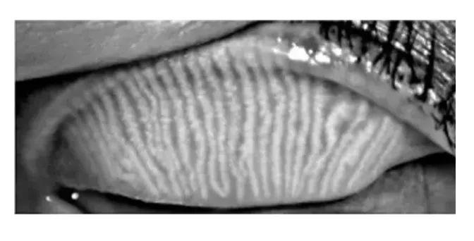 “眼内白丝：揭秘现象与原因” 睑板腺 科普中国 里拉 眼睛 第7张