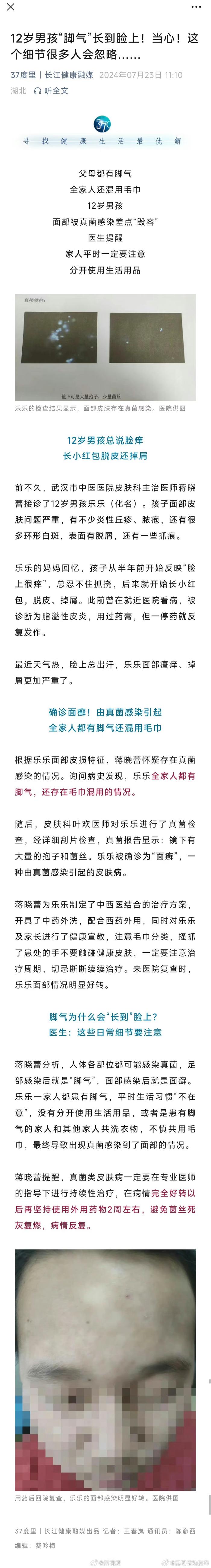 脚气为什么会长到脸上？12岁男孩脚气竟长到了脸上