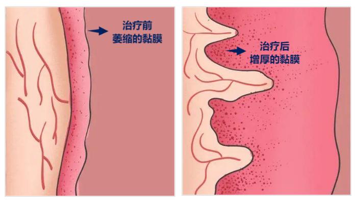 【科普】盆底康复“黑科技”