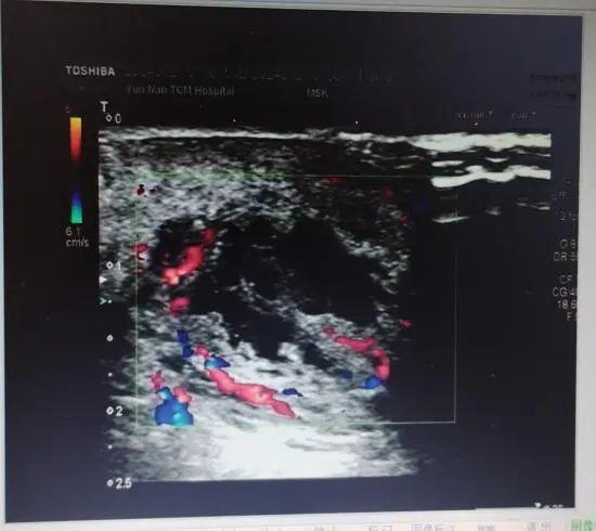 科普丨难言之隐肛周脓肿，超声检查来帮您