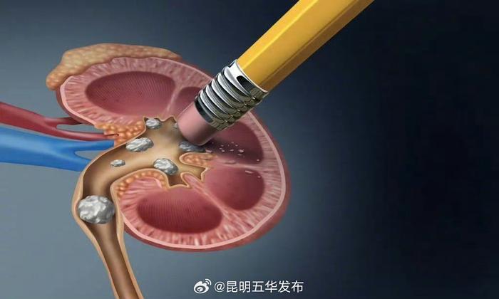 真正危险的肾结石可能仅轻微疼痛