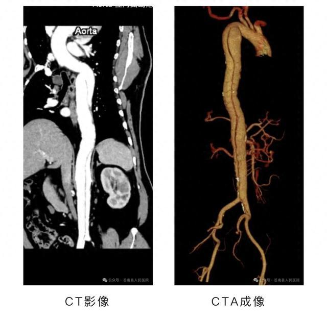 50厘米！温州男子动脉夹层从胸口撕裂到大腿！医生：随时可能死亡……