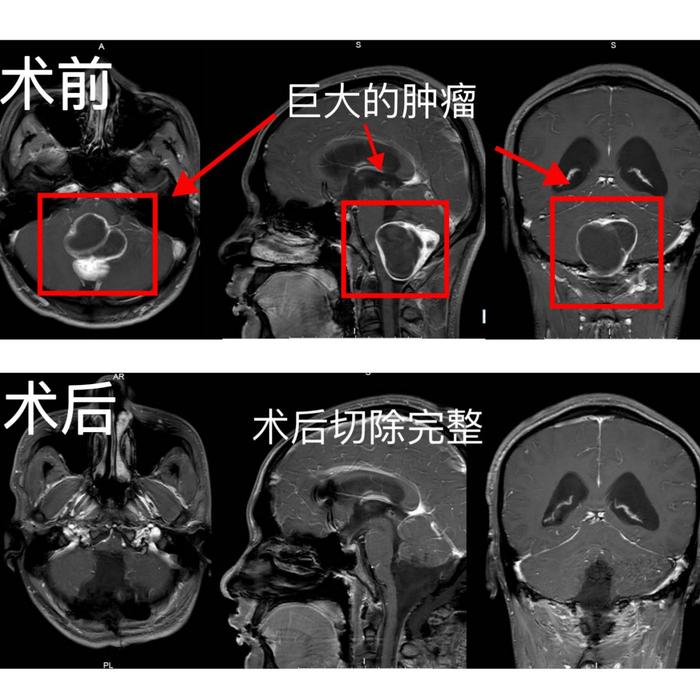 当小脑的平衡被超重肿瘤打破 看岳阳市中心医院施展“显微魔法”