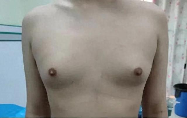 男性乳房发育，小心是种“病”！“胸大”的尴尬到底该如何破？(图1)