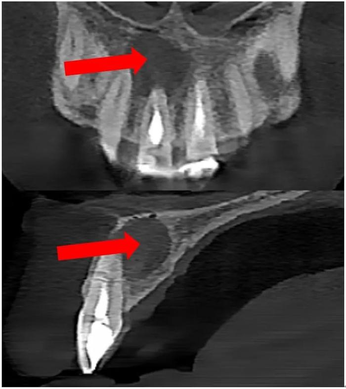 科普丨牙龈“长包”要重视，小心是根尖囊肿!