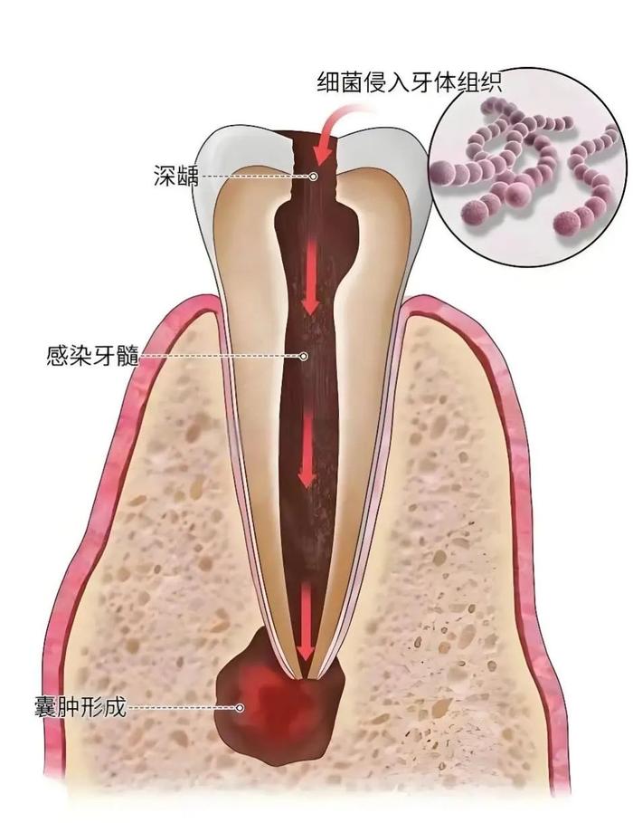 科普丨牙龈“长包”要重视，小心是根尖囊肿!