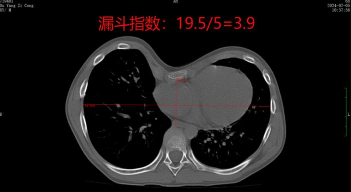 点赞 | 8岁少年胸口凹陷如“漏斗”，医生妙手助“挺”胸→(图1)