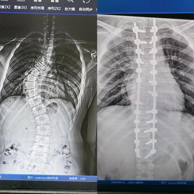 暑期上海儿童脊柱侧弯门诊就诊量激增，侧弯幅度超45度需手术矫正