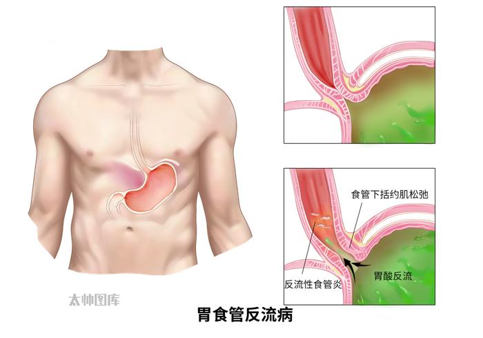 一天几杯“续命”！杭州女子总感觉喉咙被卡住！医生提醒