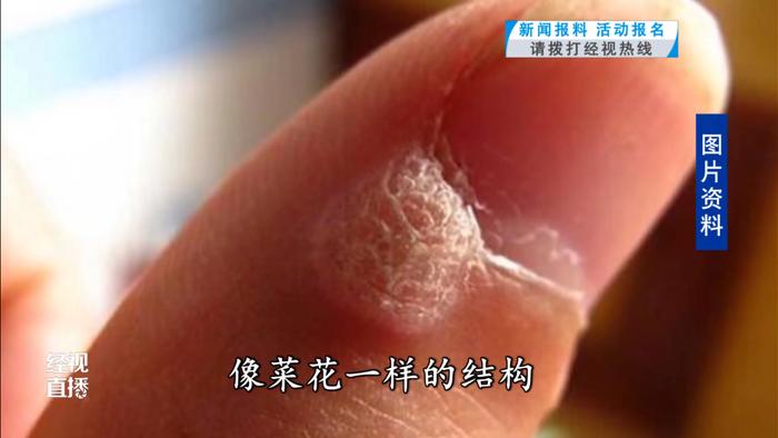 做完美甲竟感染HPV！医生提醒：这个细节一定要注意