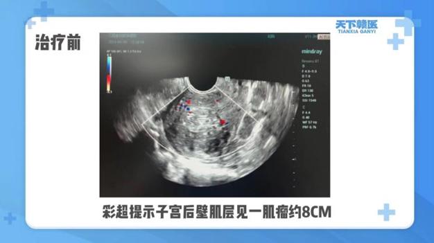 南昌28岁女子经常头晕，以为是贫血，一查竟是……