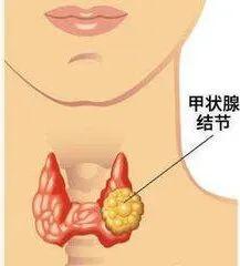 【疾病防治】如何区别甲状腺结节的良、恶性(图5)