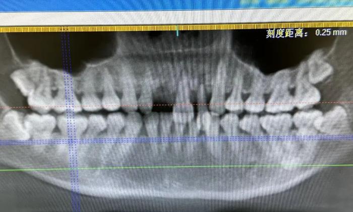 一晚上好几例！有人磕掉 3 颗门牙！医生：建议泡在牛奶里