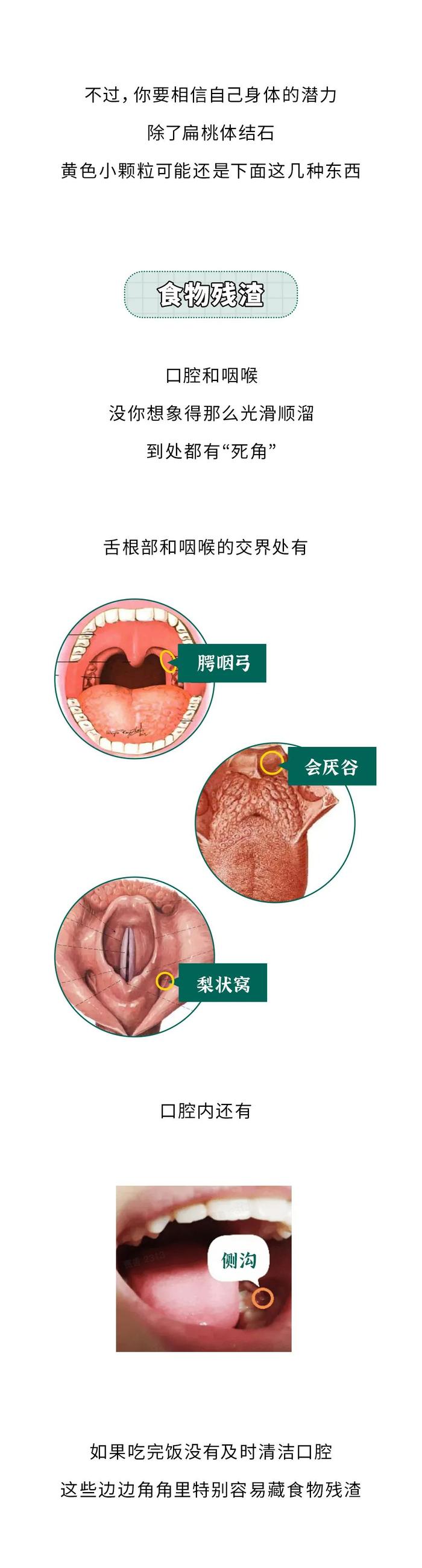 嘴里咳出来贼臭的黄色小颗粒，到底是啥？？？