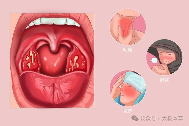 急性咽炎、扁桃体炎，用上“扁桃三药”，所向披靡(图1)