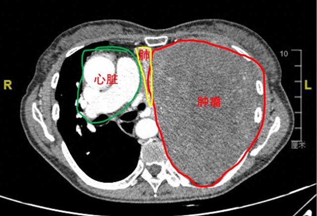 巨大胸腔肿瘤压迫心脏移位，医生巧手摘瘤保肺(图1)