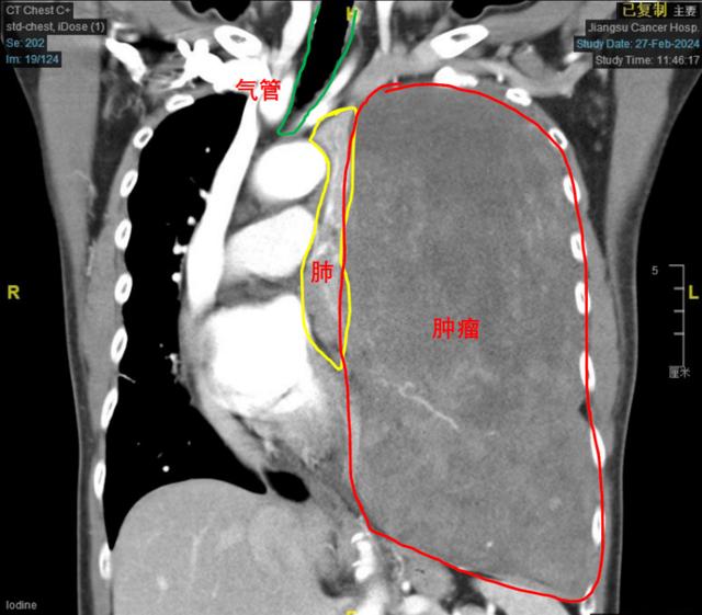 巨大胸腔肿瘤压迫心脏移位，医生巧手摘瘤保肺(图2)