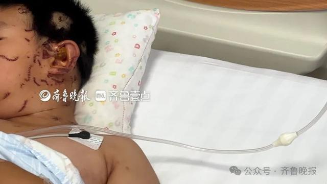 突然炸开！男童全脸30多处伤，只因家里这个“玩具”……医生提醒