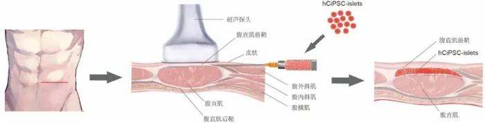 实现功能性治愈糖尿病！我国科学家取得新突破