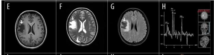 因头痛、视物模糊，颅内肿块反复住院，最后竟是SLE！(图2)