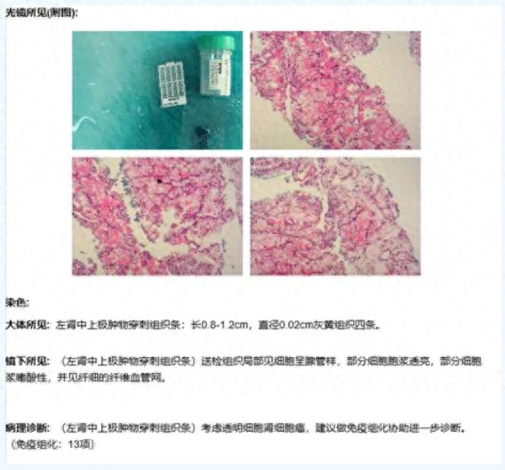 确诊肝癌再遭肾癌打击！东莞市滨海湾中心医院多学科协作为患者“拆弹”(图1)