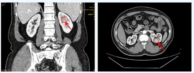 确诊肝癌再遭肾癌打击！东莞市滨海湾中心医院多学科协作为患者“拆弹”(图2)