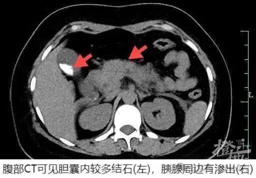 一口气吃掉4只，女子连夜送医，这道菜很多人爱吃