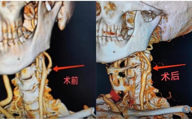 78岁老人颈动脉重度狭窄，颈动脉内膜斑块切除术畅通“生命长河”(图3)