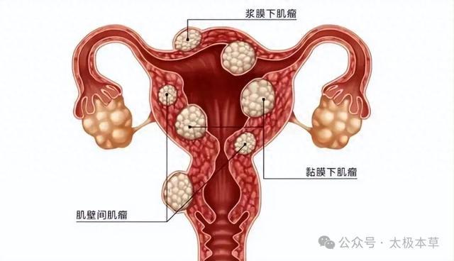 老中医：屡用有效的子宫肌瘤治验方(图1)