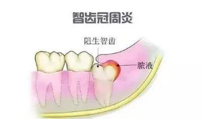 您了解什么是智齿冠周炎吗 | 郑州市口腔医院 张睿(图3)