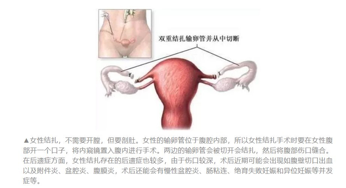 上环包里面有什么我们都知道,避孕的方式还有多种,比如外用避孕药——包括避孕药膏、药膜_新闻资讯_第3张_活检穿刺产品网 上环包里面有什么我们都知道,避孕的方式还有多种,比如外用避孕药——包括避孕药膏、药膜_https://www.jmylbn.com_新闻资讯_第3张