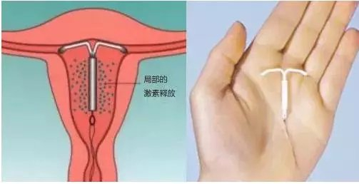上环包里面有什么我们都知道,避孕的方式还有多种,比如外用避孕药——包括避孕药膏、药膜_新闻资讯_第1张_活检穿刺产品网 上环包里面有什么我们都知道,避孕的方式还有多种,比如外用避孕药——包括避孕药膏、药膜_https://www.jmylbn.com_新闻资讯_第1张