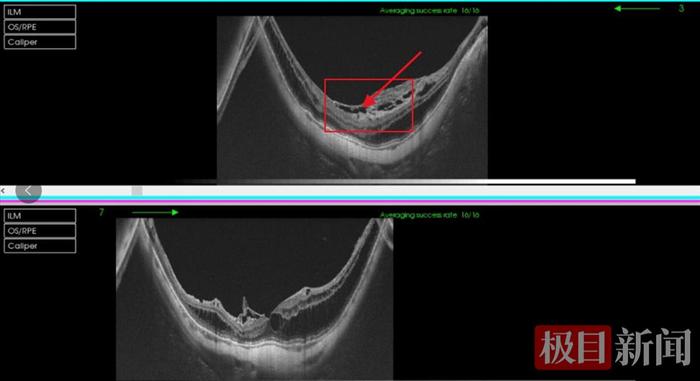 高度近视引起视网膜劈裂，七旬婆婆视物变形(图1)