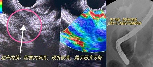 良性还是恶性?影像检查、PET-CT都无法明确……这位胆管狭窄患者的诊疗太惊心动魄(图3) 良性还是恶性?影像检查、PET-CT都无法明确……这位胆管狭窄患者的诊疗太惊心动魄(图3)