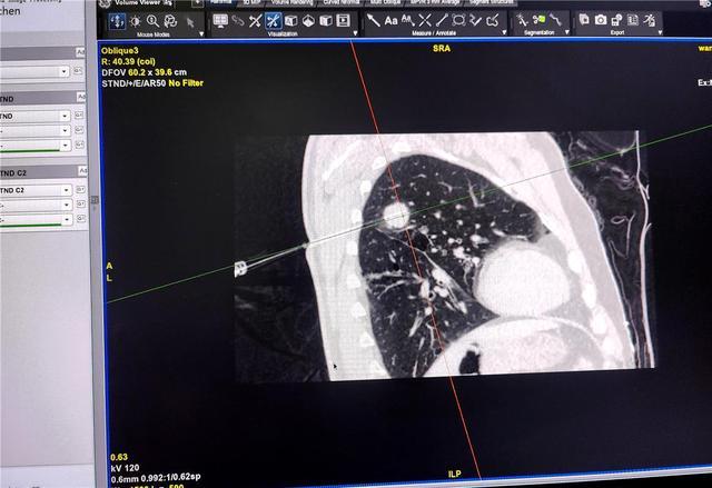 内蒙古林业总医院治疗肺部肿瘤不动刀  只有不足2毫米的针眼