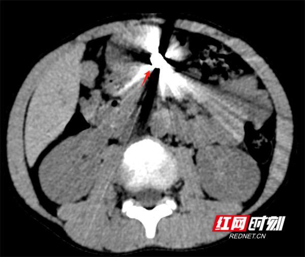 永医科普丨误吞异物怎么办 影像检查来帮忙(图5)