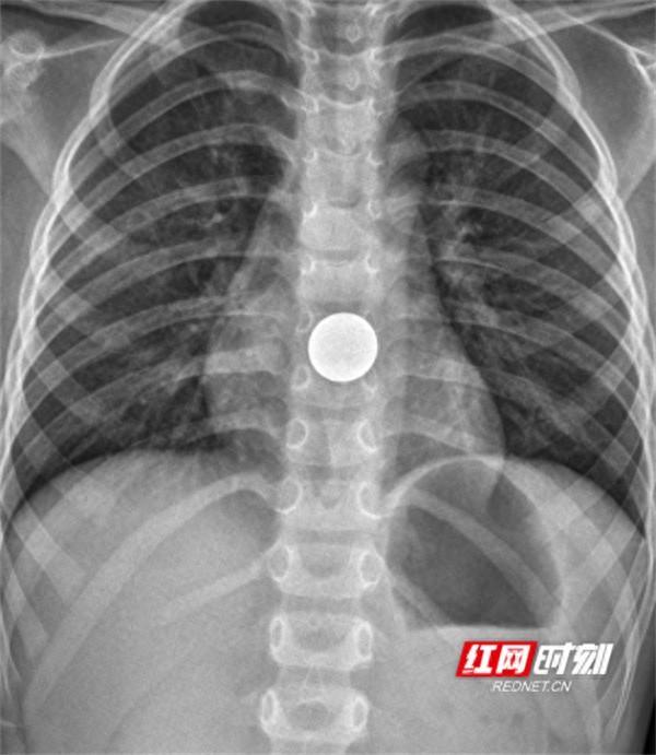 永医科普丨误吞异物怎么办 影像检查来帮忙(图1) 永医科普丨误吞异物怎么办 影像检查来帮忙(图1)