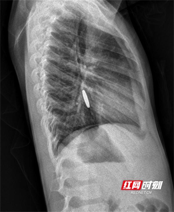 永医科普丨误吞异物怎么办 影像检查来帮忙(图2)