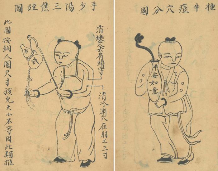 《引痘新法大全》中的接种穴位示意图